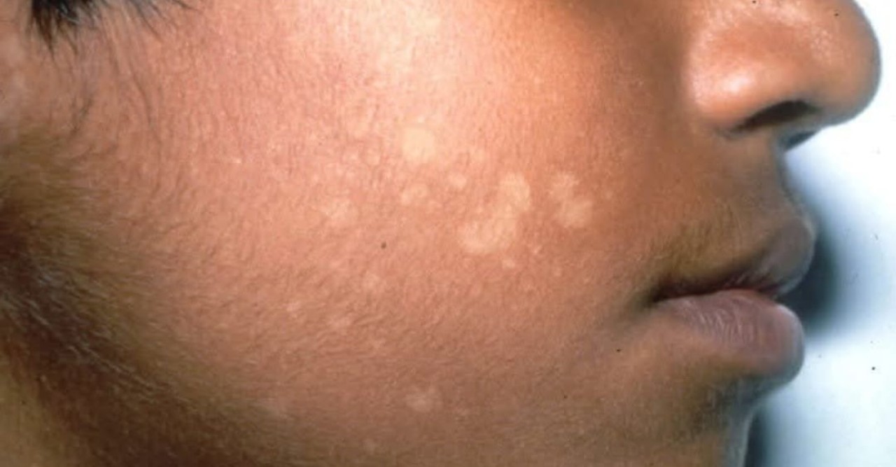 Pityriasis Versicolor- একটি ভয়াবহ ছত্রাক, সংক্রমণ প্রতিরোধে করণীয়!